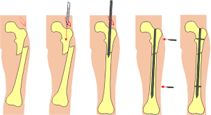 intramedullary nailing of fractures