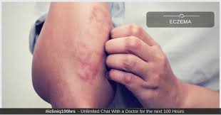 how can eczema be prevented and treated