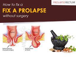 how to fix a prolapse without surgery