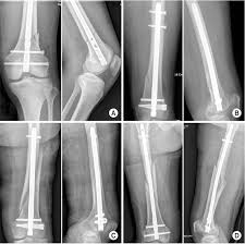 factors affecting posterior angulation