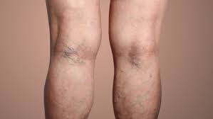 are varicose veins dangerous what are