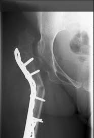 valgus osteotomy of the proximal femur