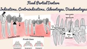 fixed partial denture indications