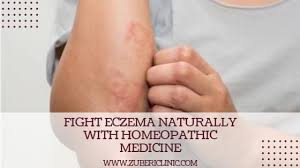 best homeopathic cine for eczema