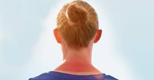 burns on the neck types causes and