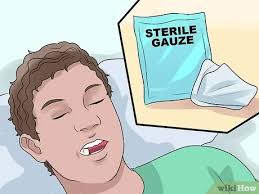 It goes without saying that you will have moderate to light bleeding it is important that the gauze stays in place as it controls the bleeding and aids in clot formation. How To Heal Gums After A Tooth Extraction With Pictures