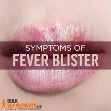 fever blisters on lips archives