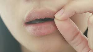 what is lip eczema and how can you
