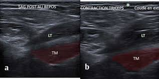 (top) image is shown through the level of the glenohumeral joint. Unknown Tendons Muscles And Nerves Of The Shoulder Proposal For A Standardized Ultrasound Guided Examination A Mini Gel Experience