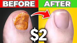 get rid of toenail fungus for good dr