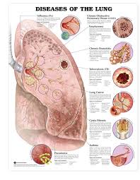 Diseases Of The Lung Anatomical Chart Poster Laminated