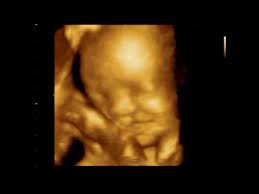 4d ultrasound cleft lip baby smiling