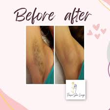 laser tattoo removal in halifax ns