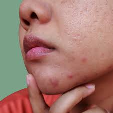 what causes chin acne and how to treat