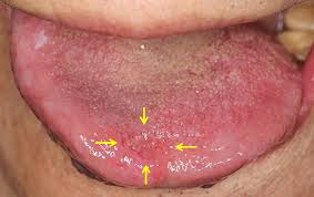 tongue with the development of cancer