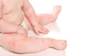 types of baby rashes which one is to