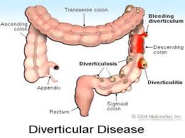 5 Diverticulitis Symptoms Diverticulum Pain Diet
