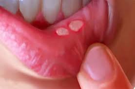 homeopathic cines for mouth ulcers