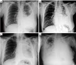 Like any other cancer issues. Clinical Diagnosis Of Malignant Pleural Mesothelioma Bianco Journal Of Thoracic Disease