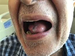 tongue cancer treated by surgery dr
