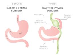 lose weight after surgery