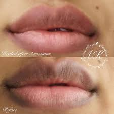 dark lip or discoloured lip correction