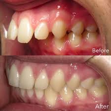 Orthodontic treatment, like braces or invisalign, may fix a mild underbite. Common Orthodontic Problems Overbite Underbite Crowding Gap Etc