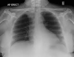 Check spelling or type a new query. Chest Ap Lordotic View Radiology Reference Article Radiopaedia Org