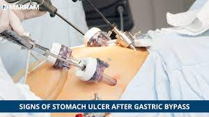 stomach ulcer after gastric byp