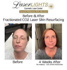 fractionated laser skin resurfacing