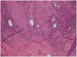 cutaneous squamous cell carcinoma