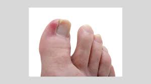 ingrown toenails causes symptoms and