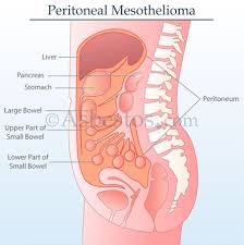 mesothelioma is often misdiagnosed in the early stages, but if your healthcare provider is aware of the increased risk, it will improve the care your receive with earlier interventions. Mesothelioma Asbestos Images Diagrams Graphs