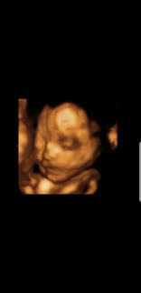 possible cleft lip 3d ultrasound