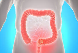 These other types of colon cancer may be treated differently than adenocarcinoma. What Does Colon Cancer Poop Look Like
