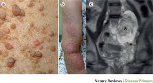 It primarily affects the skin, the nervous system and the eyes. Neurofibromatosis Type 1 Nature Reviews Disease Primers