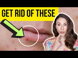 how to get rid of lip pimples fast