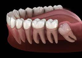 wisdom tooth surgery feel relief with