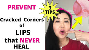 how to heal ed lip corners fast