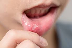 dealing with canker sores can be