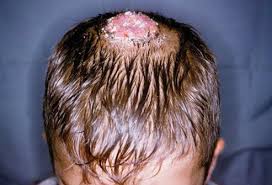 Later hair loss may be triggered by the fungal infection on scalp. Scalp Ringworm Symptoms Pictures Treatment Cure