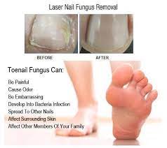 toe nail fungus anti fungal nail