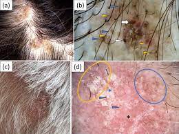 chronic cutaneous lupus erythematosus