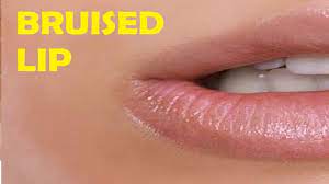 how to get rid of a bruise on your lip