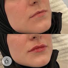 botox and filler treatment lips