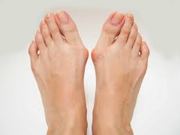 what can i do about my bunions