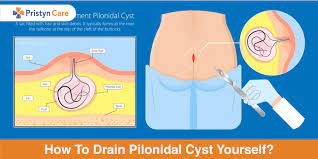 how to drain pilonidal cyst yourself