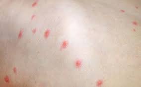 symptoms during the ses of shingles
