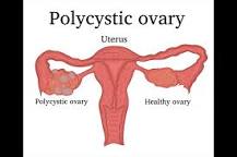 how-do-u-know-if-u-have-pcos