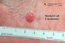 merkel cell carcinoma murky cell